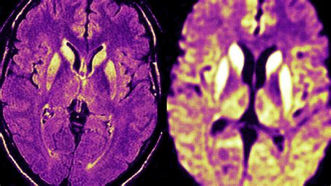 Prion Disease Rising in the U.S. | MedPage Today