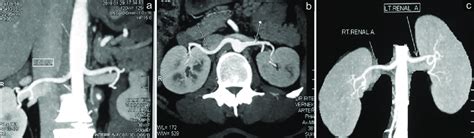 (a-c) Computed tomography renal angiography showing a single renal... | Download Scientific Diagram