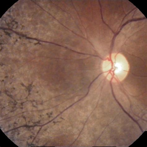 peripheral anterior synechiae in OD. Abbreviation: OD, right eye. | Download Scientific Diagram