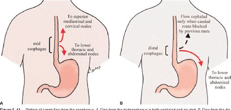 Figure 5–12 from Adenocarcinoma of the Esophagus and Gastroesophageal ...