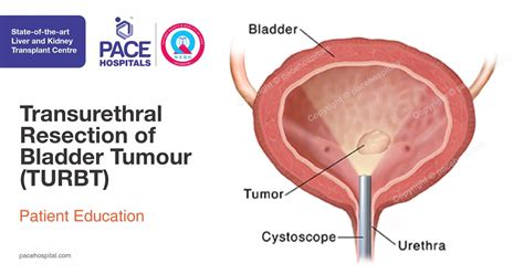 Transurethral Resection of Bladder Tumour (TURBT)