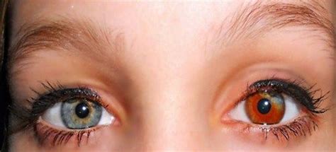 Heterochromia iridum - Wikipedia, the free encyclopedia | Heterochromia ...