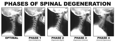 Spinal Degeneration Phases | Monitto Chiropractic