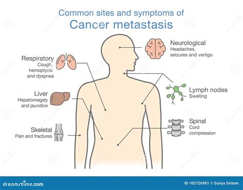 Most Common Sites And Symptoms Of Cancer Metastasis. Stock Vector - Illustration of metastatic ...