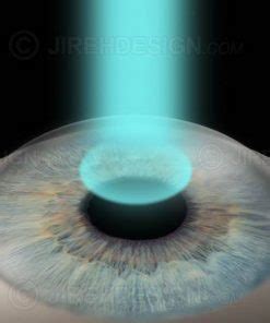 Retina surgery air bubble - #SUVR0014 | Stock eye images