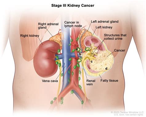 Renal Cell Cancer Treatment (PDQ®)–Health Professional Version - Siteman Cancer Center