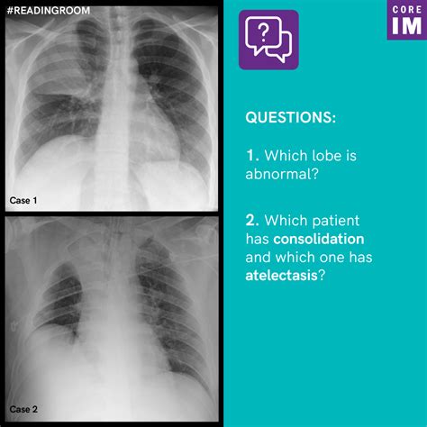 What is the difference between atelectasis vs. consolidation? | Core IM Podcast