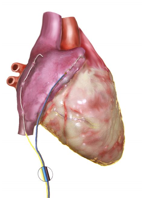 Implantation of the Syncrus(TM) Internal Cardioversion System for ...