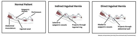 Direct And Indirect Inguinal Hernia