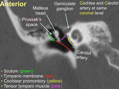 Temporal Bone Ct Anatomy - Anatomy Reading Source