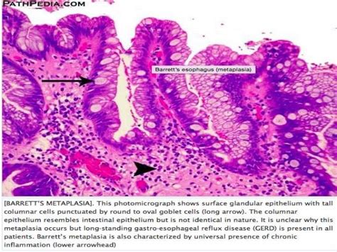 Barrett's Oesophagus for the Histopathologist.