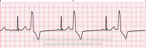 Ventricular and Heart Blocks Flashcards | Quizlet