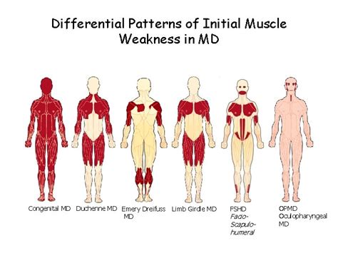 Muscular Dystrophies What is Muscular Dystrophy MD MD