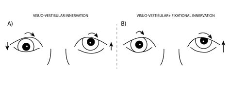 Vision Therapy For Dissociated Vertical Deviation