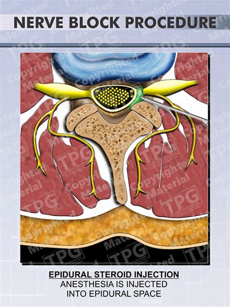 Epidural Nerve Block Procedure - Order