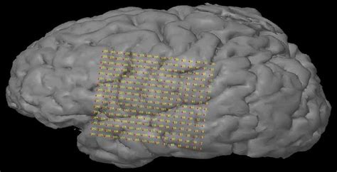 Grid of ECoG electrodes superimposed on an MRI reconstruction of the... | Download Scientific ...