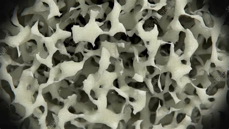 Osteoporosis weakening bone, animation - Stock Video Clip - K011/3665 - Science Photo Library