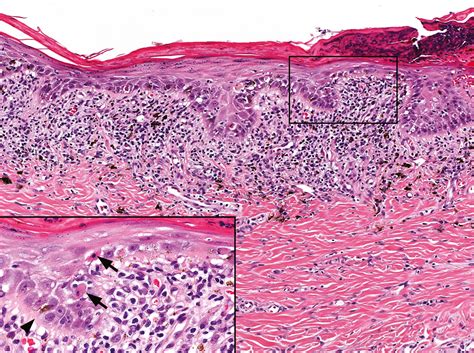 Clinical and microscopic features of generalized discoid lupus erythematosus in dogs (10 cases ...