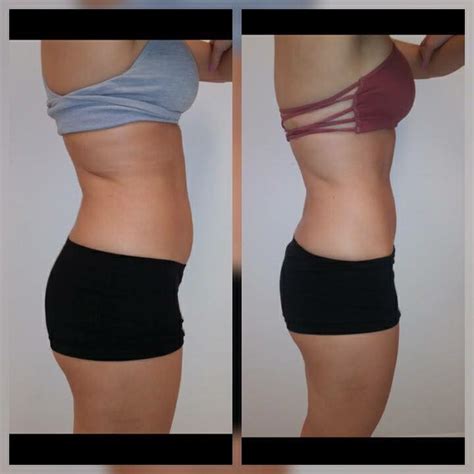 Nonsurgical Body Sculpting & Skin Tightening NO Surgery NO Downtime