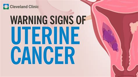 The Most Common Warning Sign of Uterine Cancer - YouTube