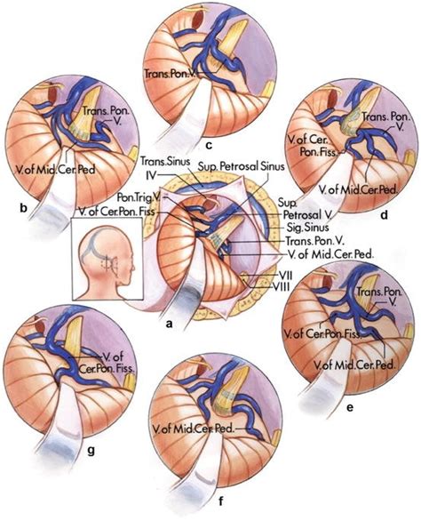 Microsurgical Anatomy for Microvascular Decompression Surgery | SpringerLink