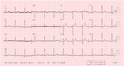 ECGlibrary.com: Normal adult 12-lead ECG