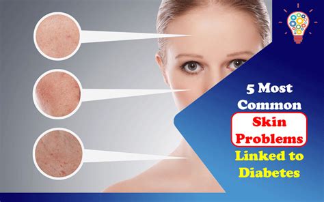 5 Most Common Skin Problems Linked To Diabetes - Updated Ideas