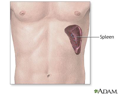 Post-splenectomy complications - UF Health