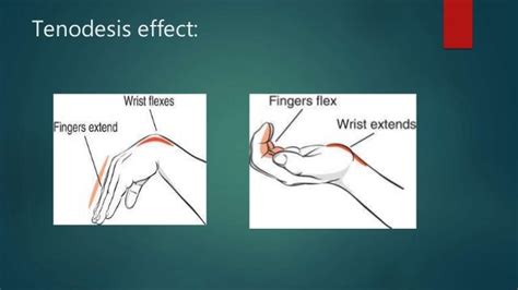 PRINCIPLES OF TENDON TRANSFERS