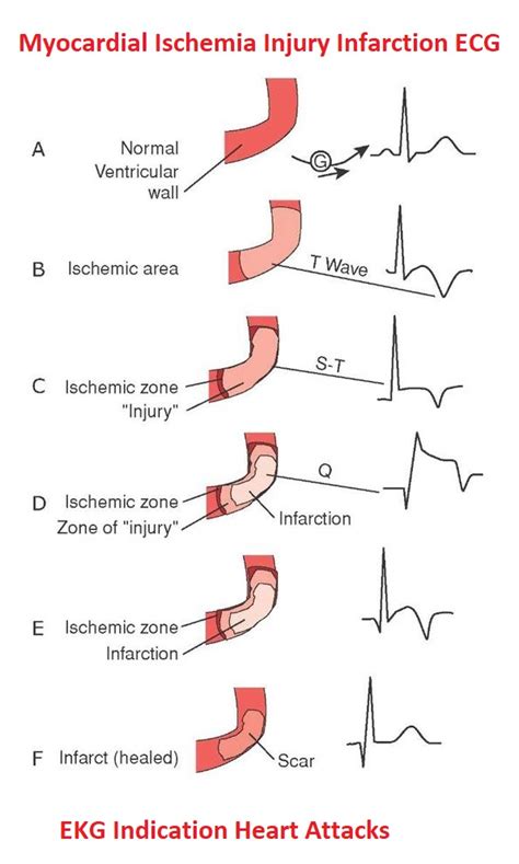 ECG Indications of Myocardial Ischemia, Injury & Infarction - NCLEX Quiz