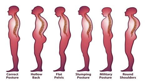 5 Exercises to Fix Hunchback Posture and Stop Slouching - WomenWorking