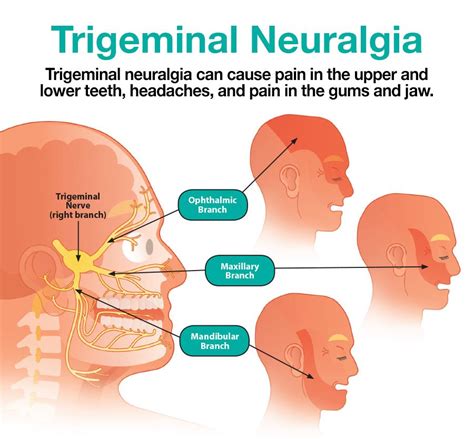 Trigeminal Neuralgia Treatment