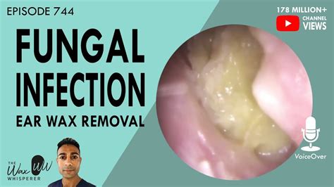 744 - Fungal Ear Infection Ear Wax Removal - YouTube