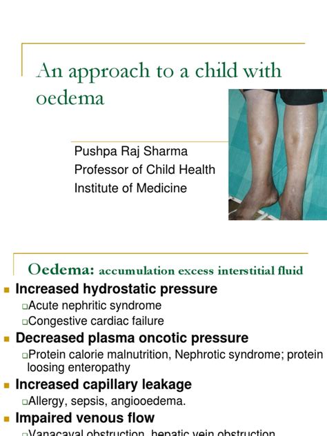 An Approach to a Child With Oedema | Edema | Medical Specialties