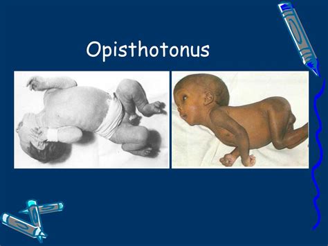 Opisthotonos Definition Position Causes Treatment