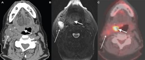 Oral HPV16 Infection Precedes Head and Neck Cancer - National Cancer Institute