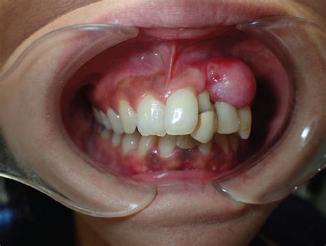 Fibrous epulis: A tumorlike gingival lesion | Cleveland Clinic Journal ...