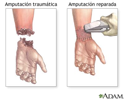 Reparación de amputación: MedlinePlus enciclopedia médica illustración