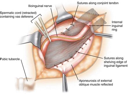 Inguinal Hernia - General & Bariatric Surgery of South Florida | Dr. Alvaro Garcia