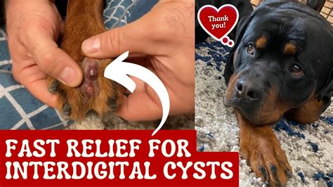 Fast Relief For Interdigital Cysts - YouTube