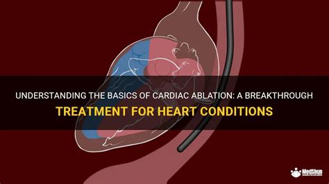 Understanding The Basics Of Cardiac Ablation: A Breakthrough Treatment For Heart Conditions ...