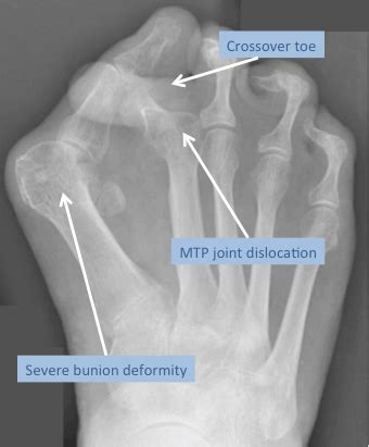 MTP Joint Dislocation | Mr Malik Orthopaedic Consultant