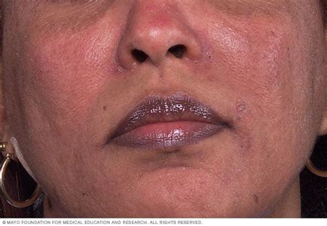 Rosacea - Symptoms and causes - Mayo Clinic