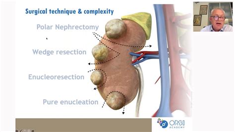 Urowebinar: Update on robot assisted partial nephrectomy - YouTube