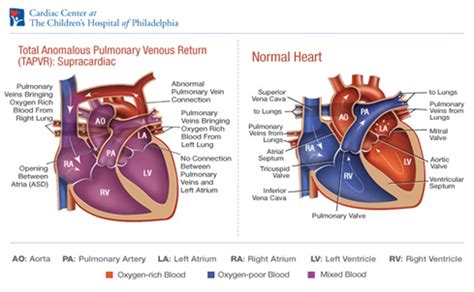 Total Anomalous Pulmonary Venous Return (TAPVR) - Cardiothoracic Surgery