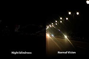 Nyctalopia Treatment Torrance CA | Night Blindness Treatment Long Beach CA