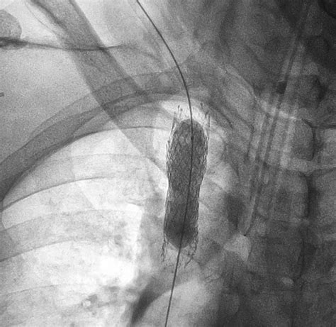 Ballooning of Sioxx stent placed at obstruction site in superior vena cava. | Download ...