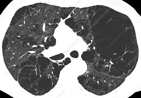 Emphysema lung disease, axial CT scan - Stock Image - C048/6073 ...