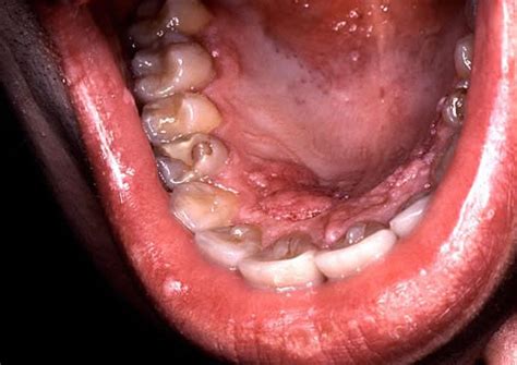 Mouth cancer from HPV virus reaches all-time high