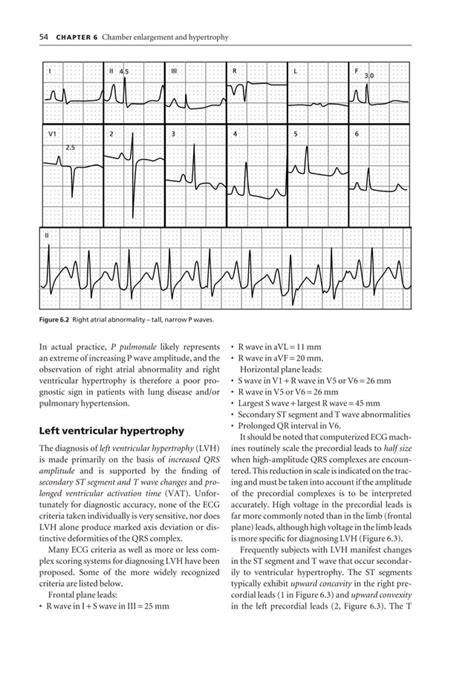 Ecg interpretation